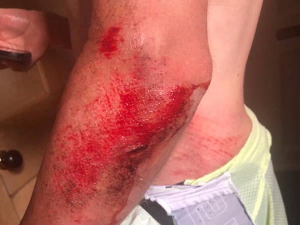 Ben injuries